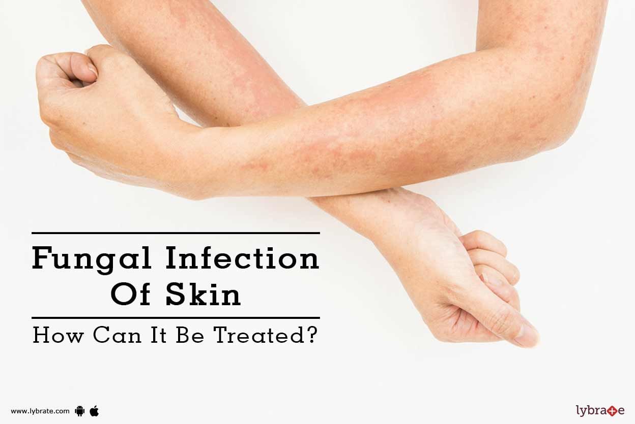 Fungal Infection Of Skin - How Can It Be Treated?