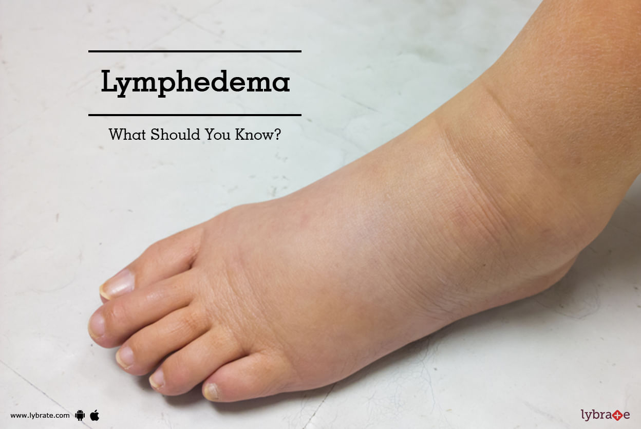 Lymphedema - What Should You Know?
