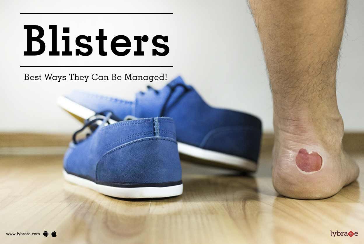 Blisters - Best Ways They Can Be Managed!