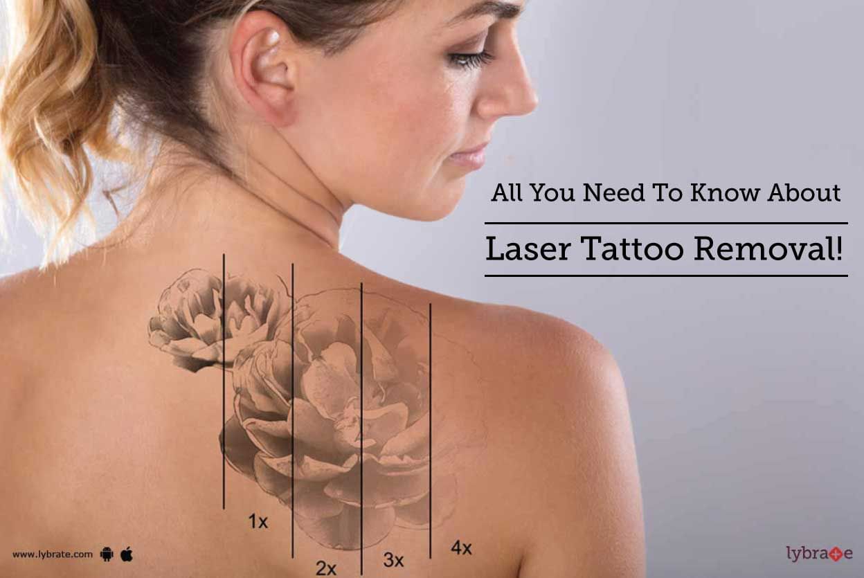 All You Need To Know About Laser Tattoo Removal!