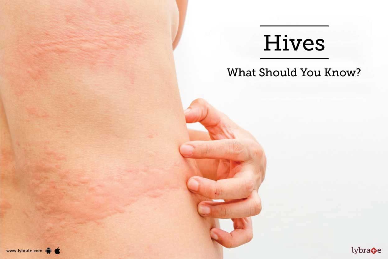 Hives - What Should You Know?