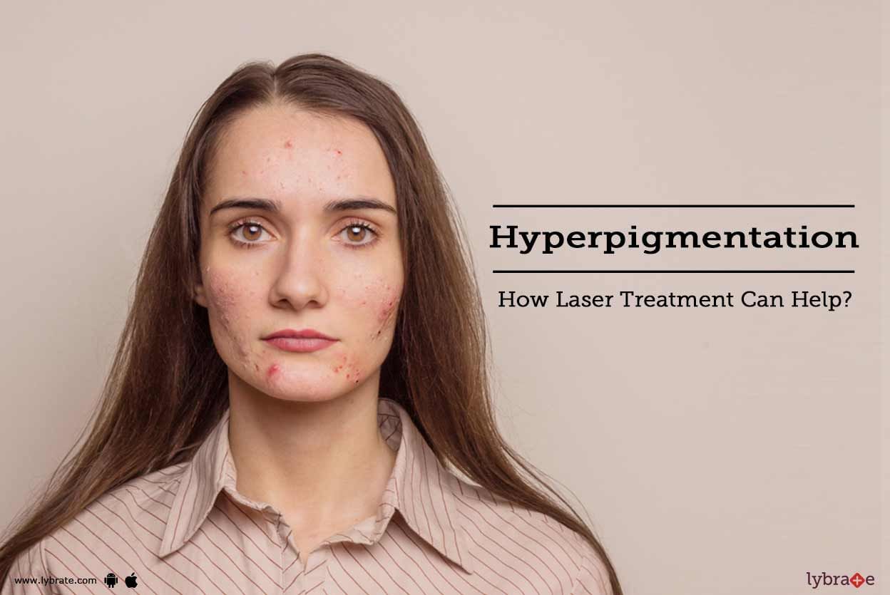 Hyperpigmentation - How Laser Treatment Can Help?