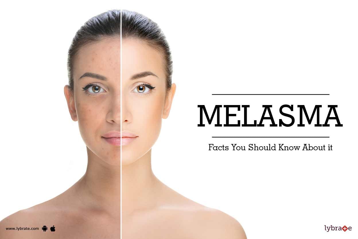 Melasma : Facts You Should Know About it