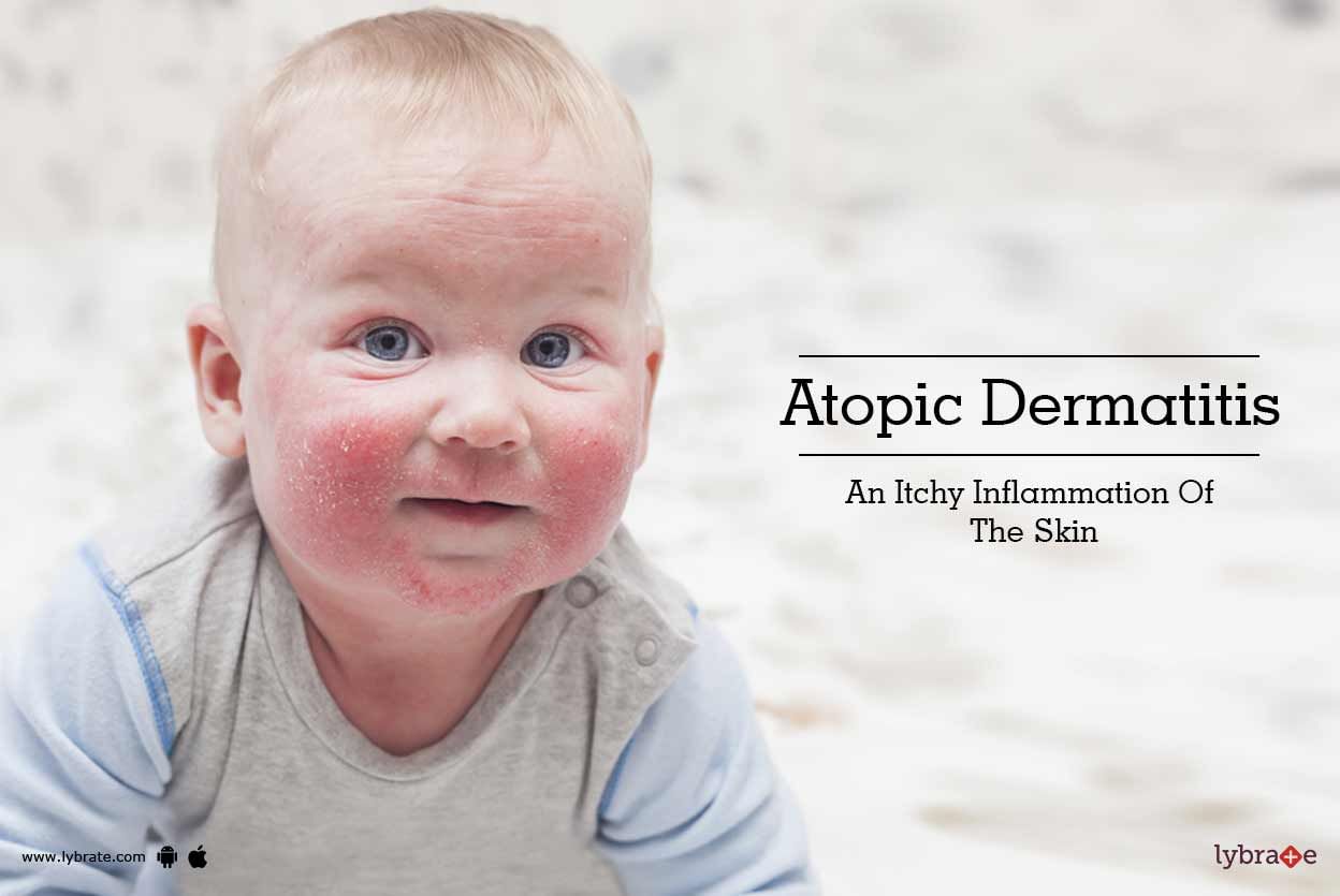 Atopic Dermatitis - An Itchy Inflammation Of The Skin