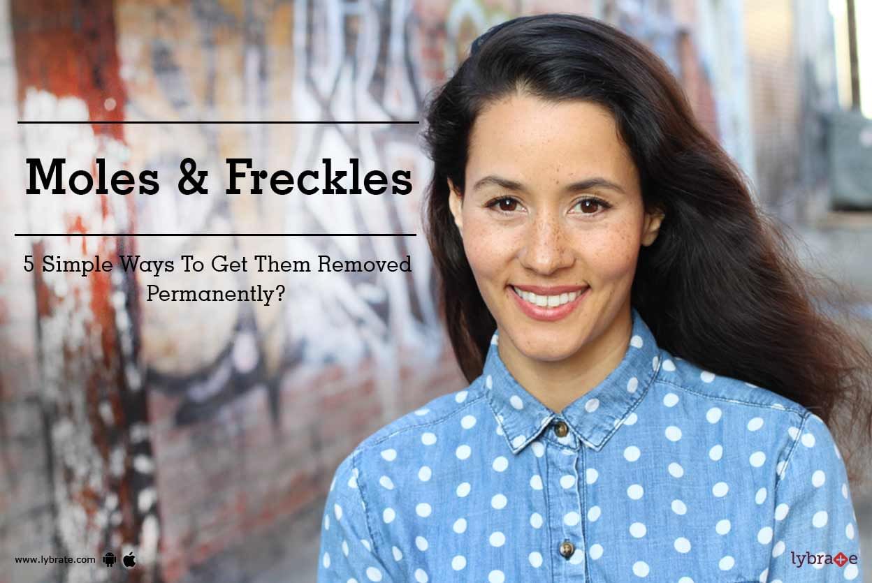 Moles & Freckles -  5 Simple Ways To Get Them Removed Permanently?