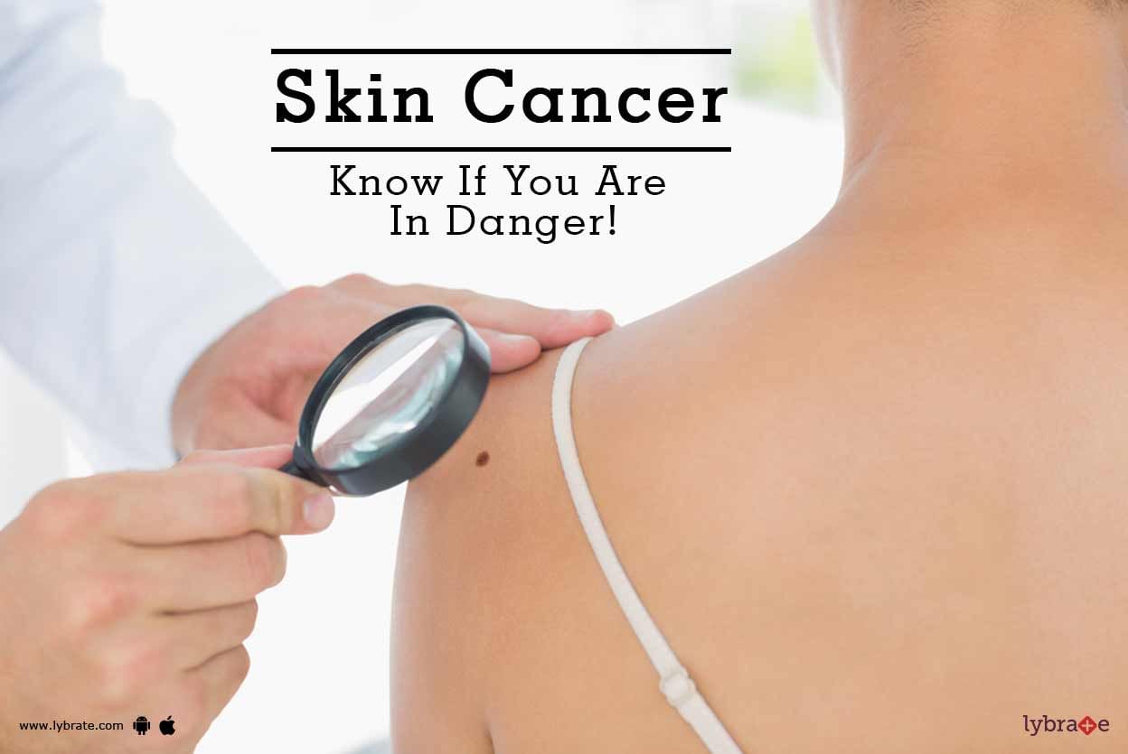 Skin Cancer - Know If You Are In Danger!
