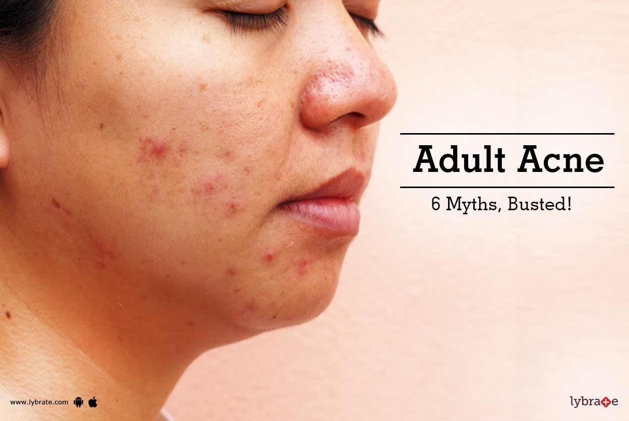 Adult Acne: 6 Myths, Busted!