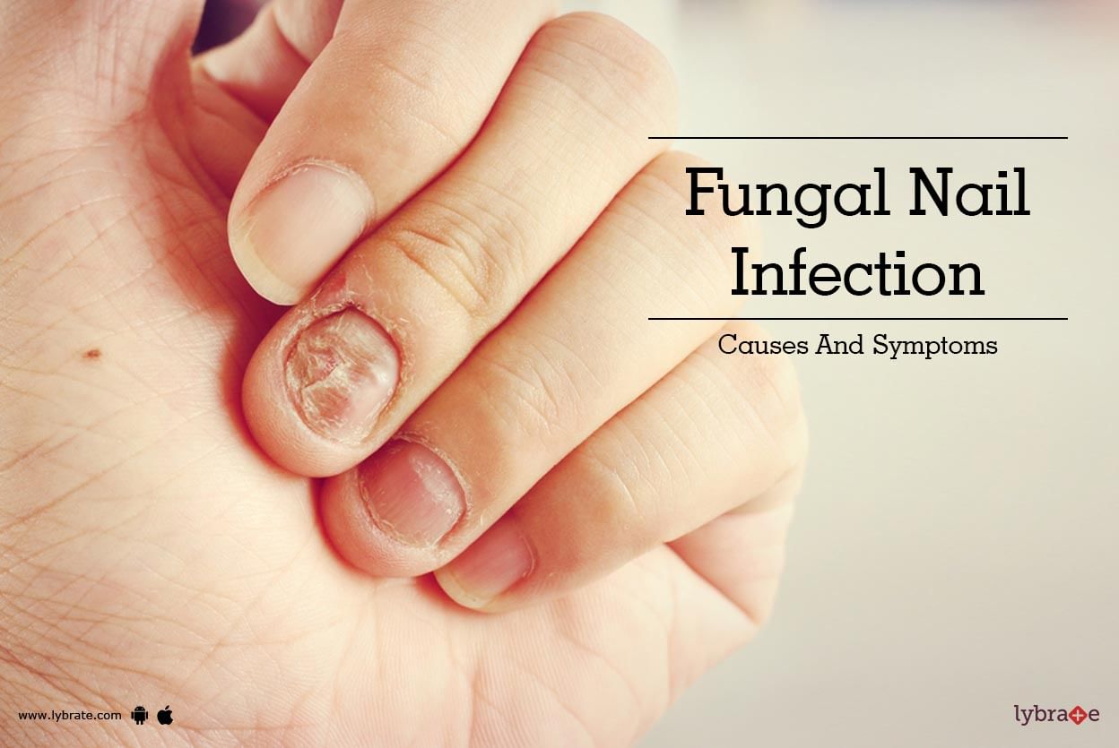 Fungal Nail Infection - Causes And Symptoms