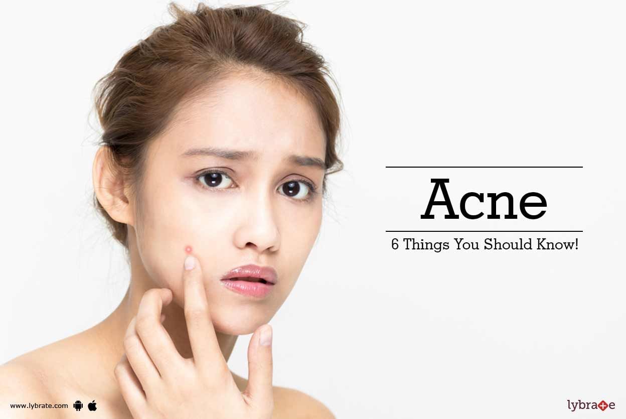 Acne - 6 Things You Should Know!
