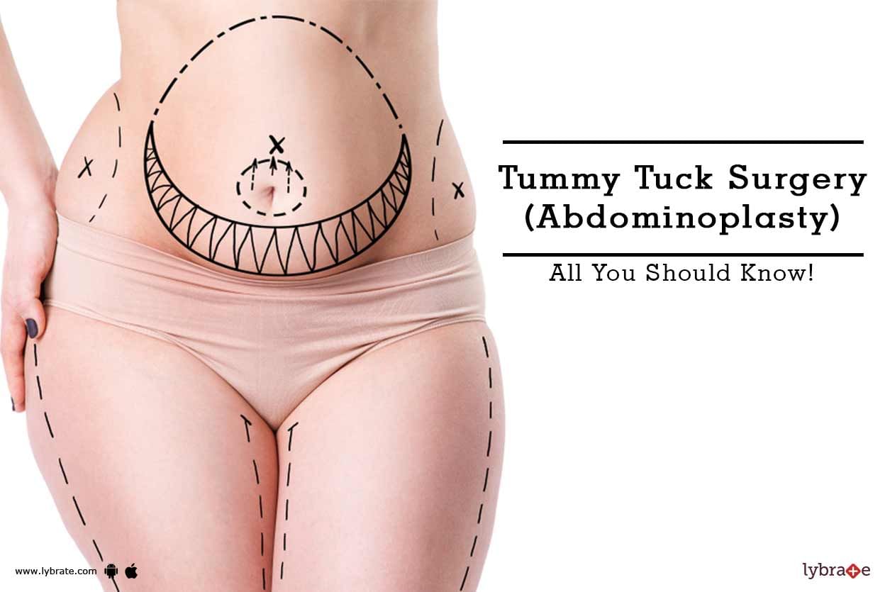 Tummy Tuck Surgery (Abdominoplasty) - All You Should Know!