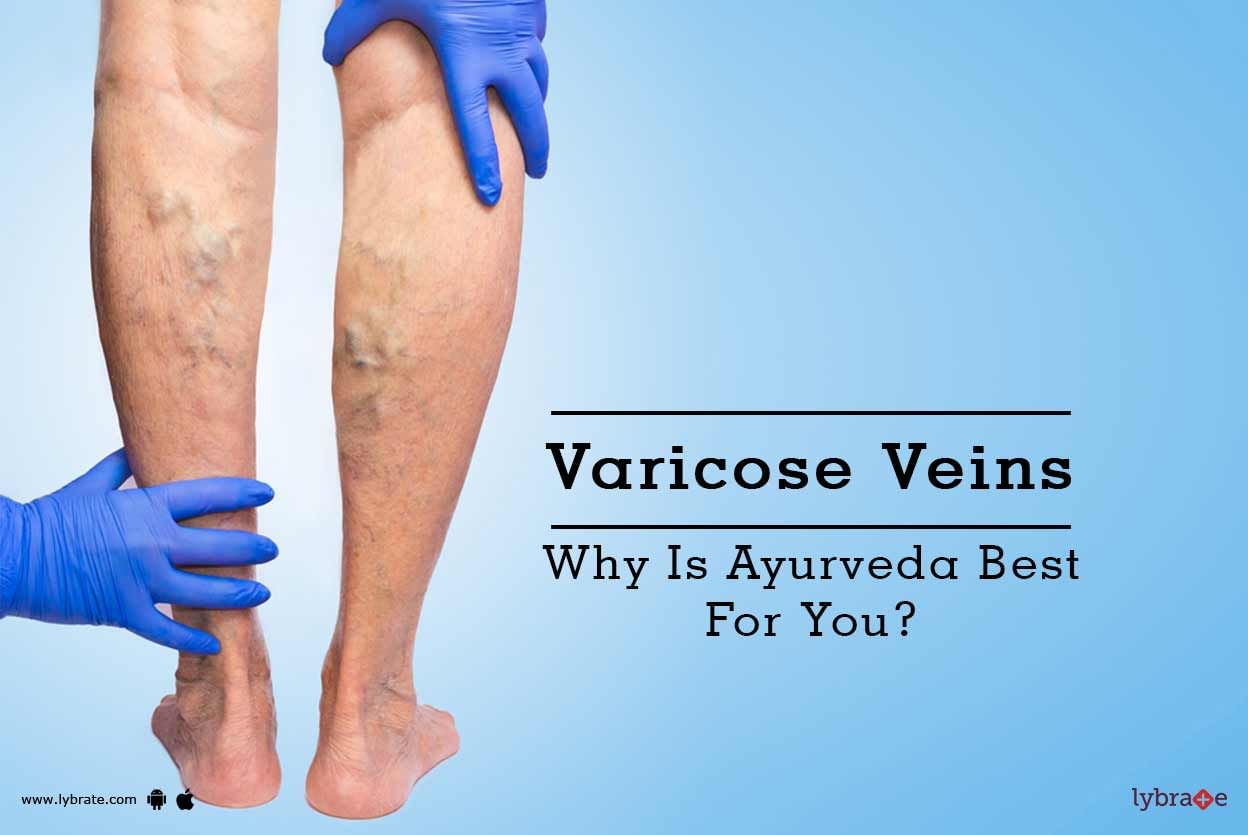 Varicose Veins - Why Is Ayurveda Best For You?