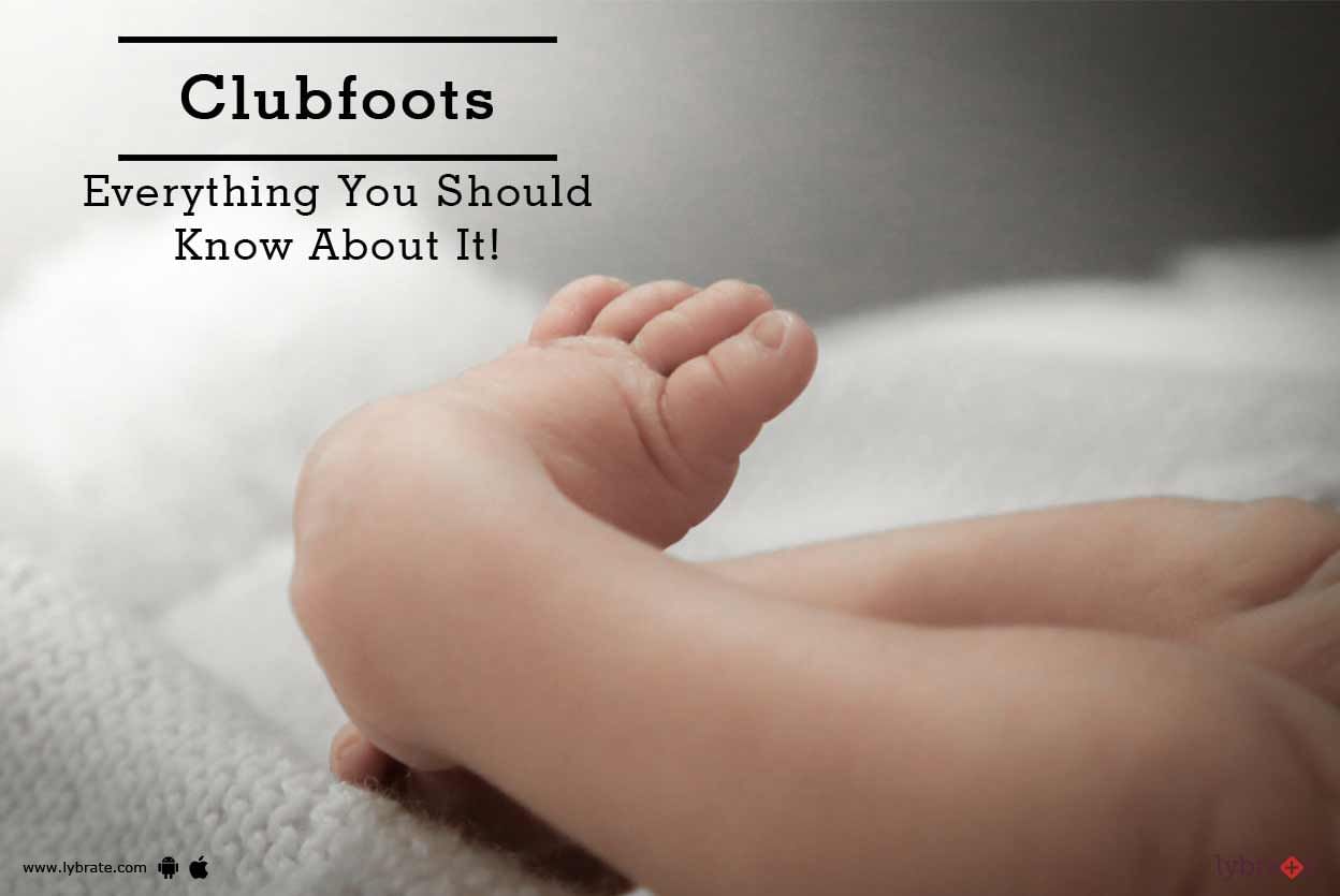 Clubfoot - Everything You Should Know About It!