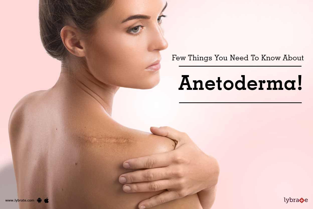 Few Things You Need To Know About Anetoderma!