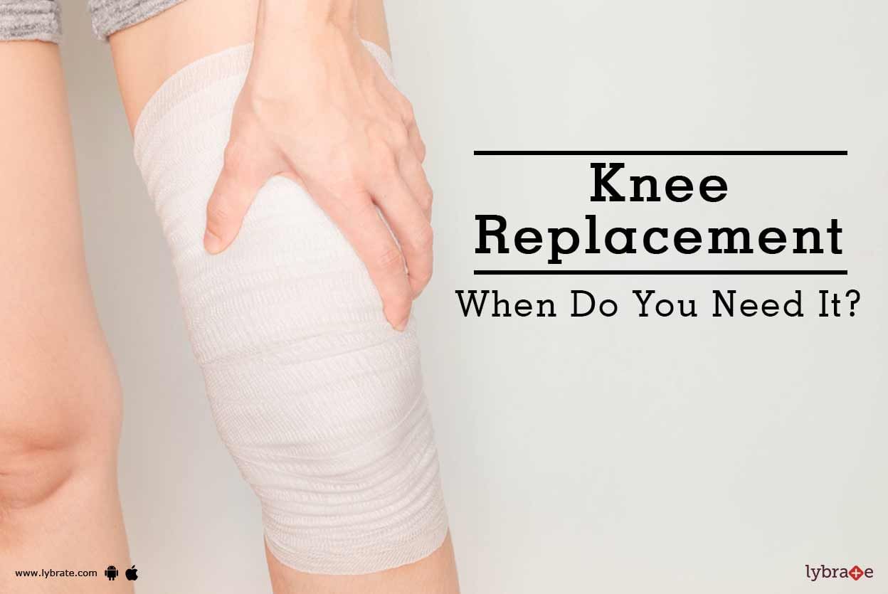 Knee Replacement - When Do You Need It?
