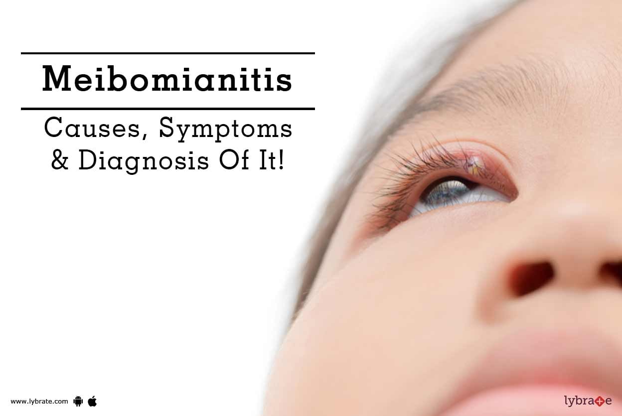 Meibomianitis - Causes, Symptoms & Diagnosis Of It!