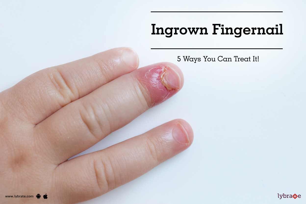 Ingrown Fingernail - 5 Ways You Can Treat It!