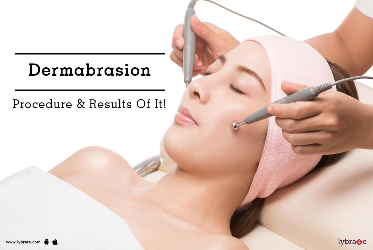 Dermabrasion - Procedure & Results Of It!