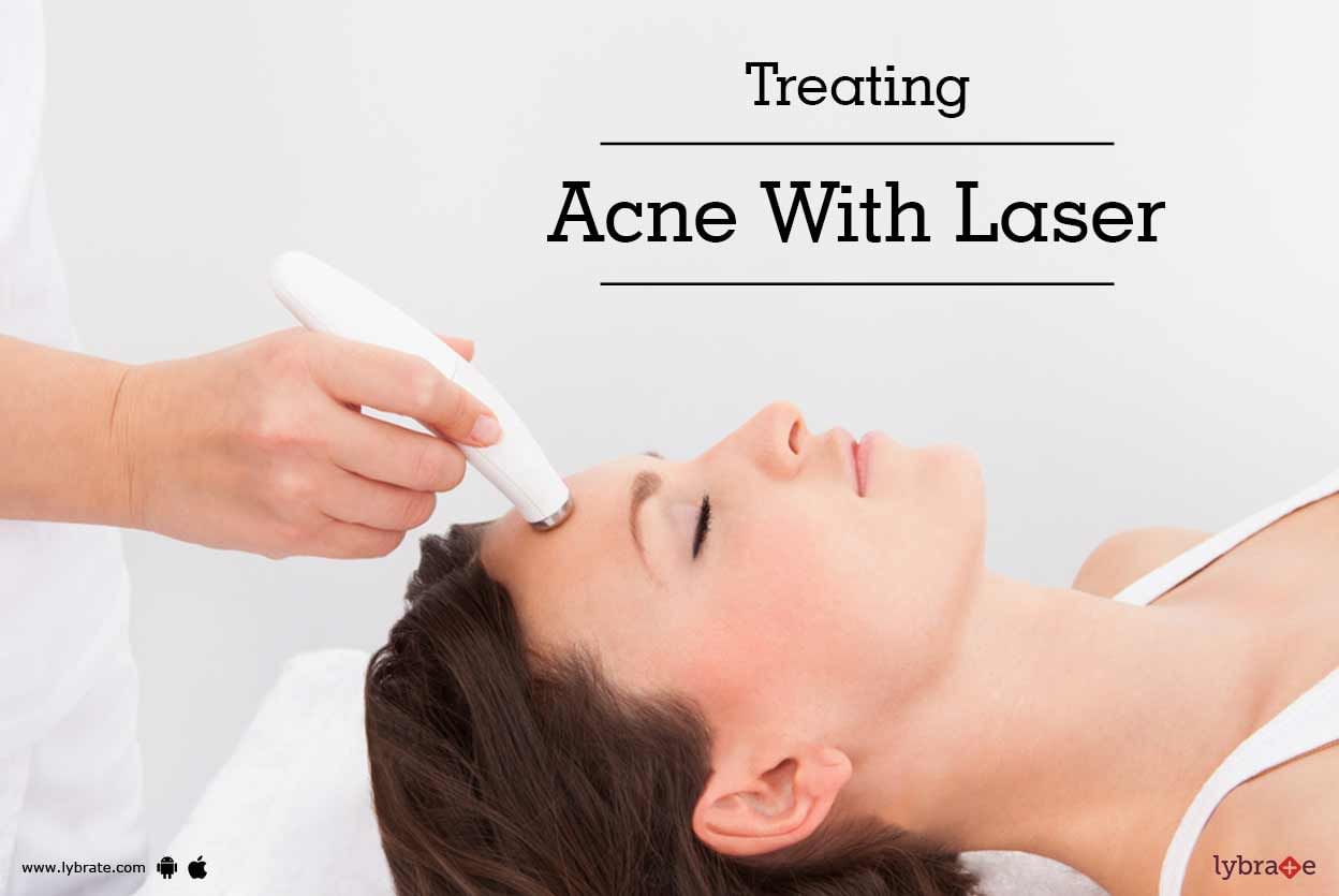 Treating Acne With Laser