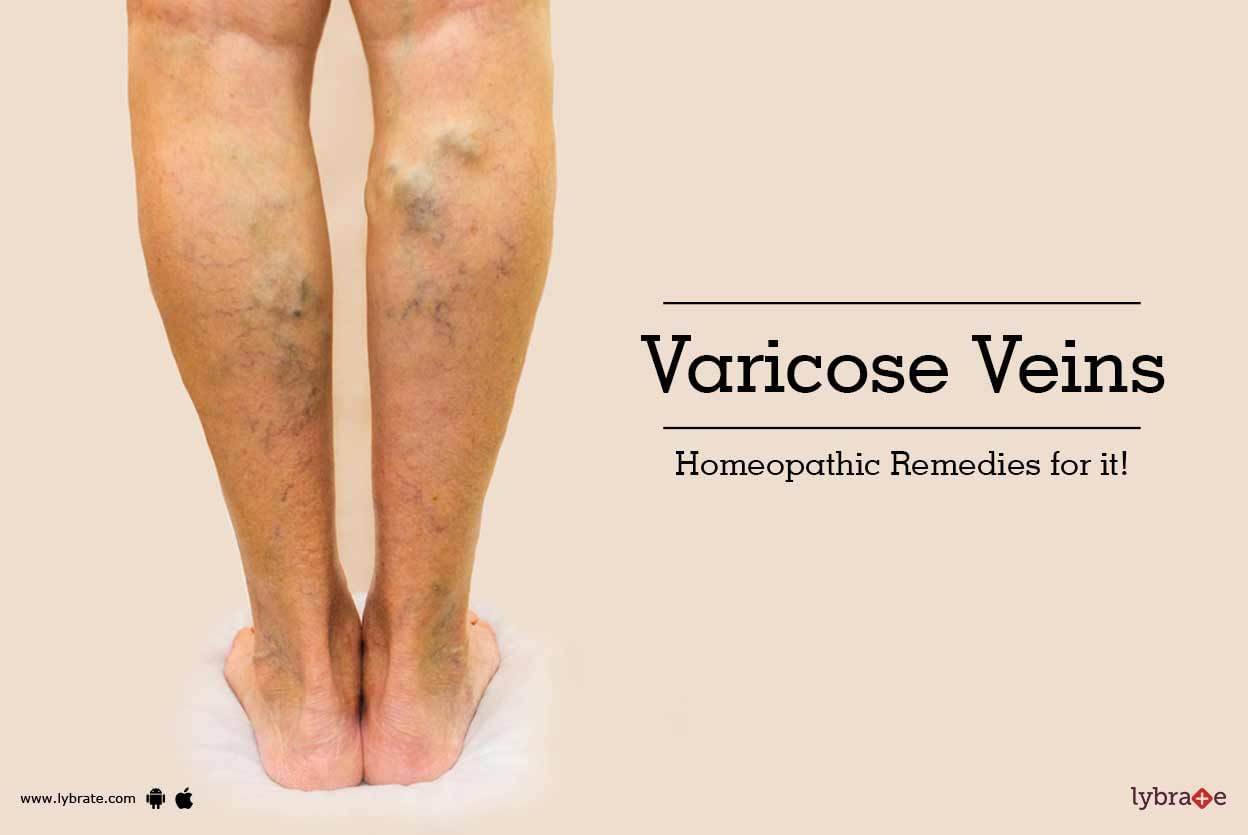 Varicose Veins - Homeopathic Remedies for it!