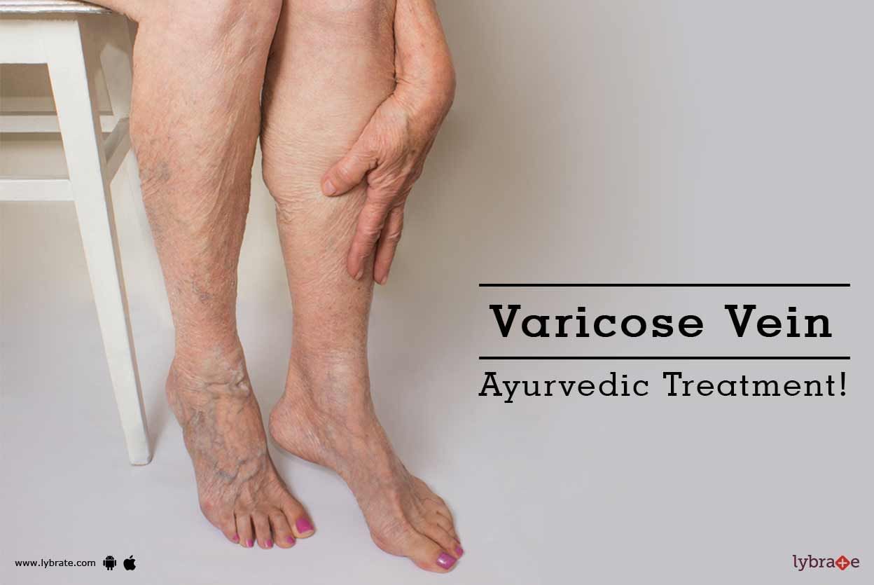 Varicose Vein - Ayurvedic Treatment!