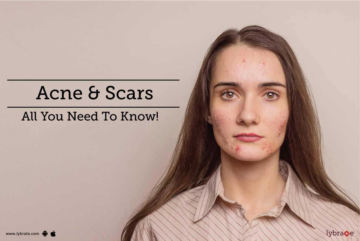 Acne & Scars - All You Need To Know!
