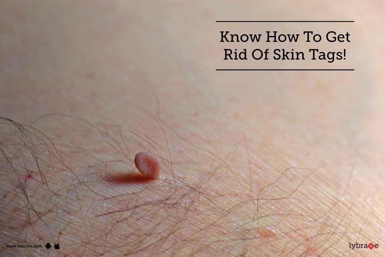 Know How To Get Rid Of Skin Tags!