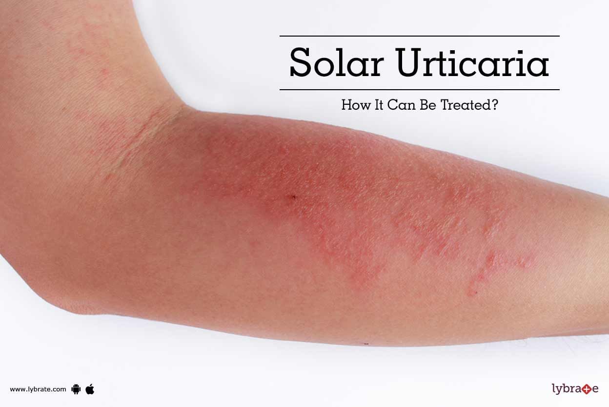 Solar Urticaria - How It Can Be Treated?