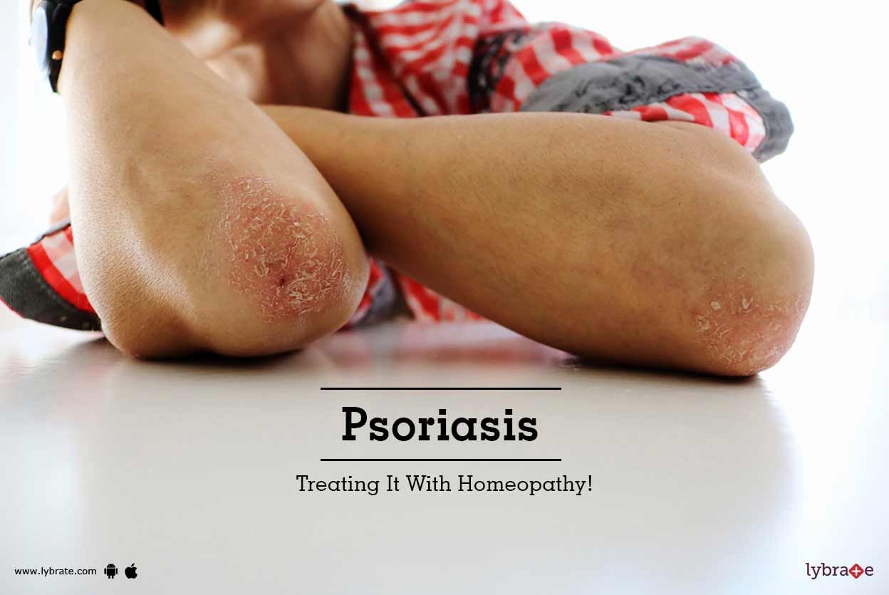 Psoriasis - Treating It With Homeopathy!