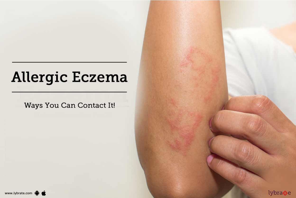 Allergic Eczema - Ways You Can Contact It!