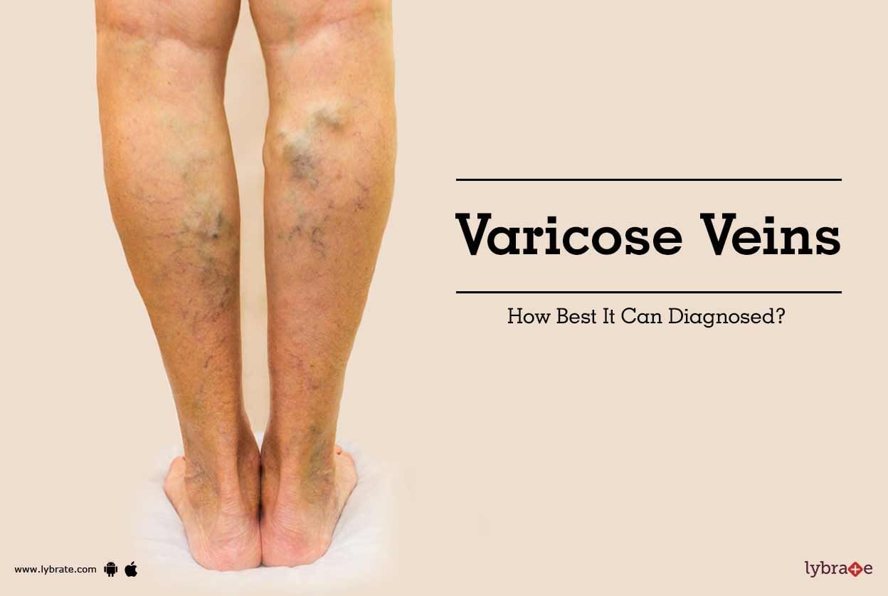 Varicose Veins - How Best It Can Diagnosed?