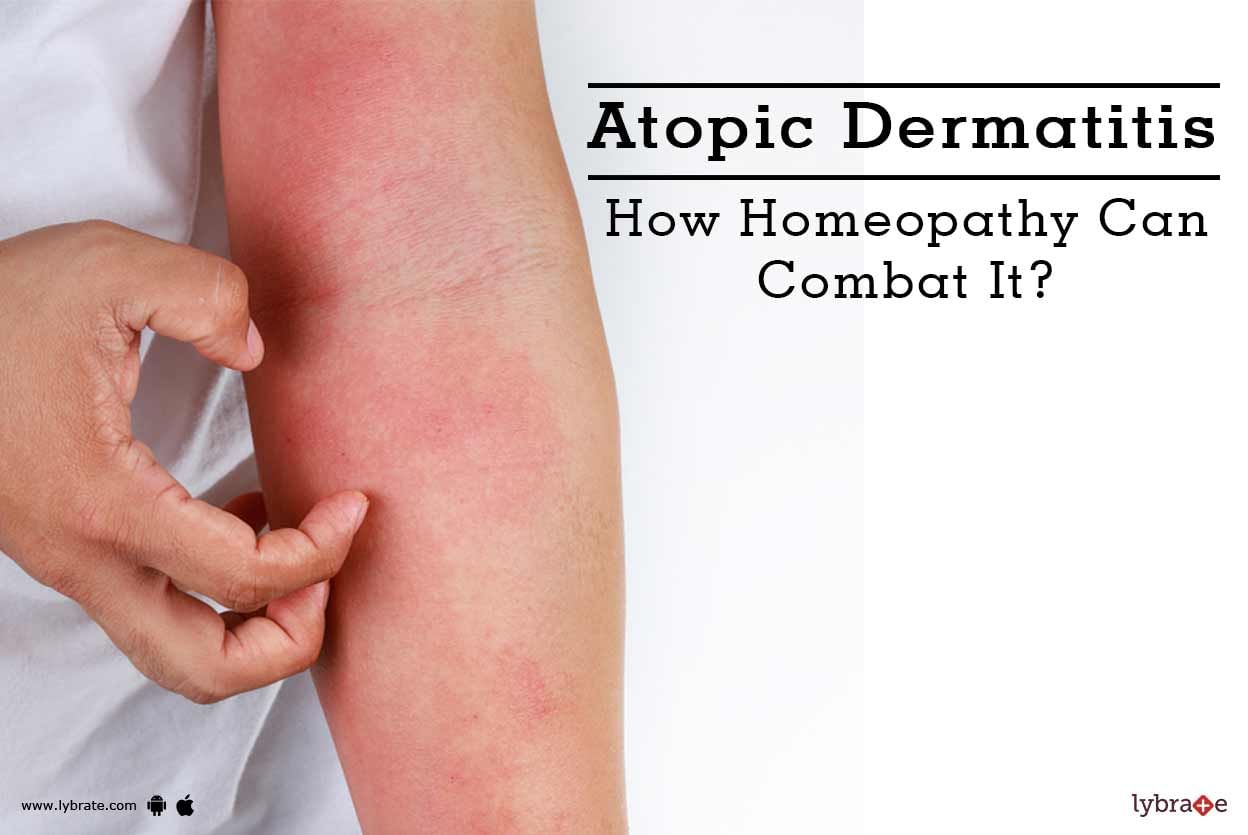 Atopic Dermatitis - How Homeopathy Can Combat It?