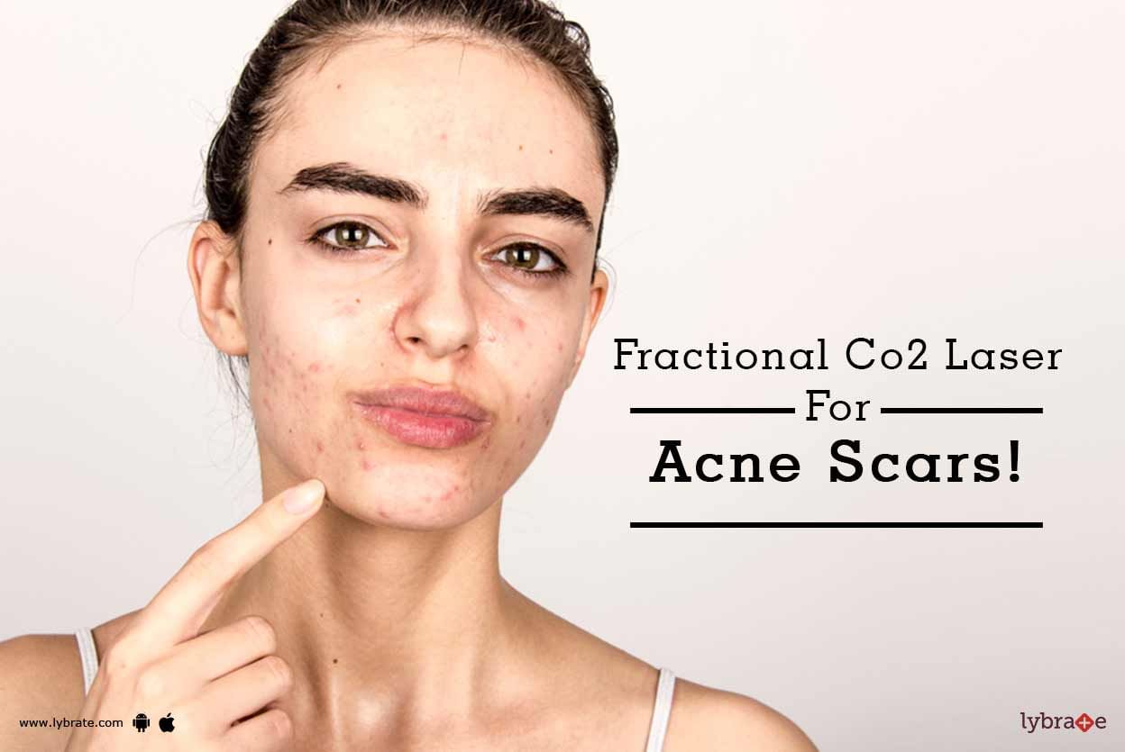 Fractional Co2 Laser For Acne Scars!