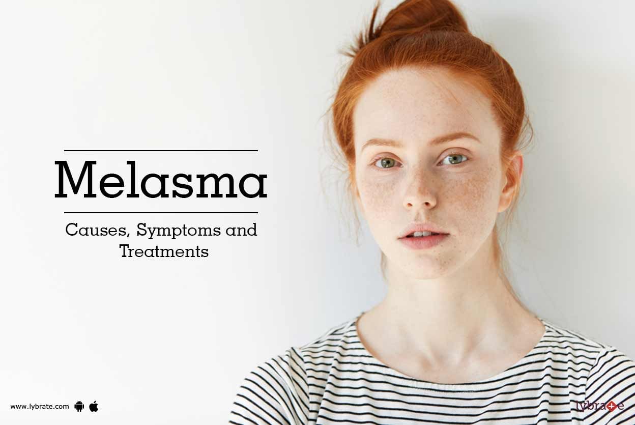 Melasma - Causes, Symptoms and Treatments