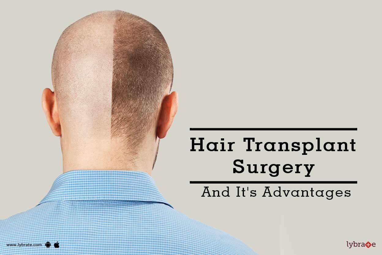 Hair Transplant Surgery And It's Advantages