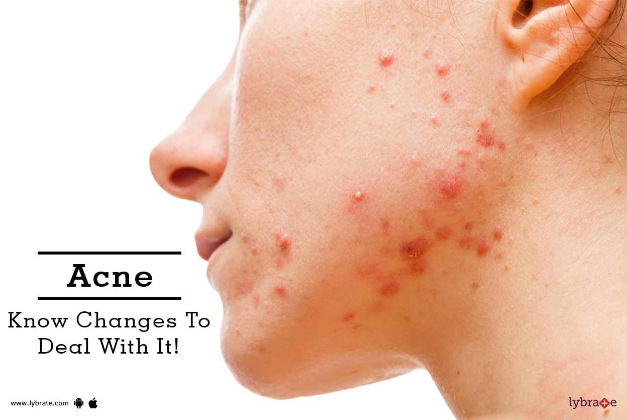 Acne - Know Changes To Deal With It!