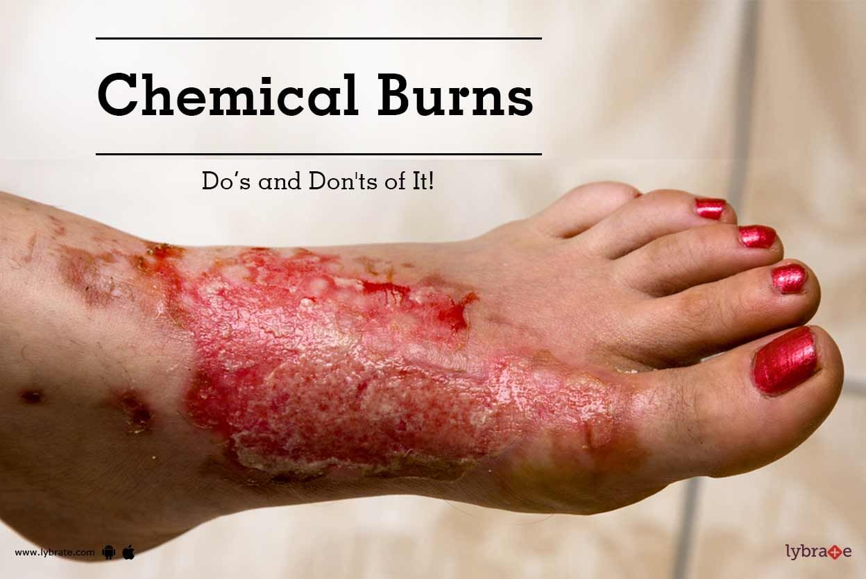 Chemical Burns - Do's and Don'ts of It!