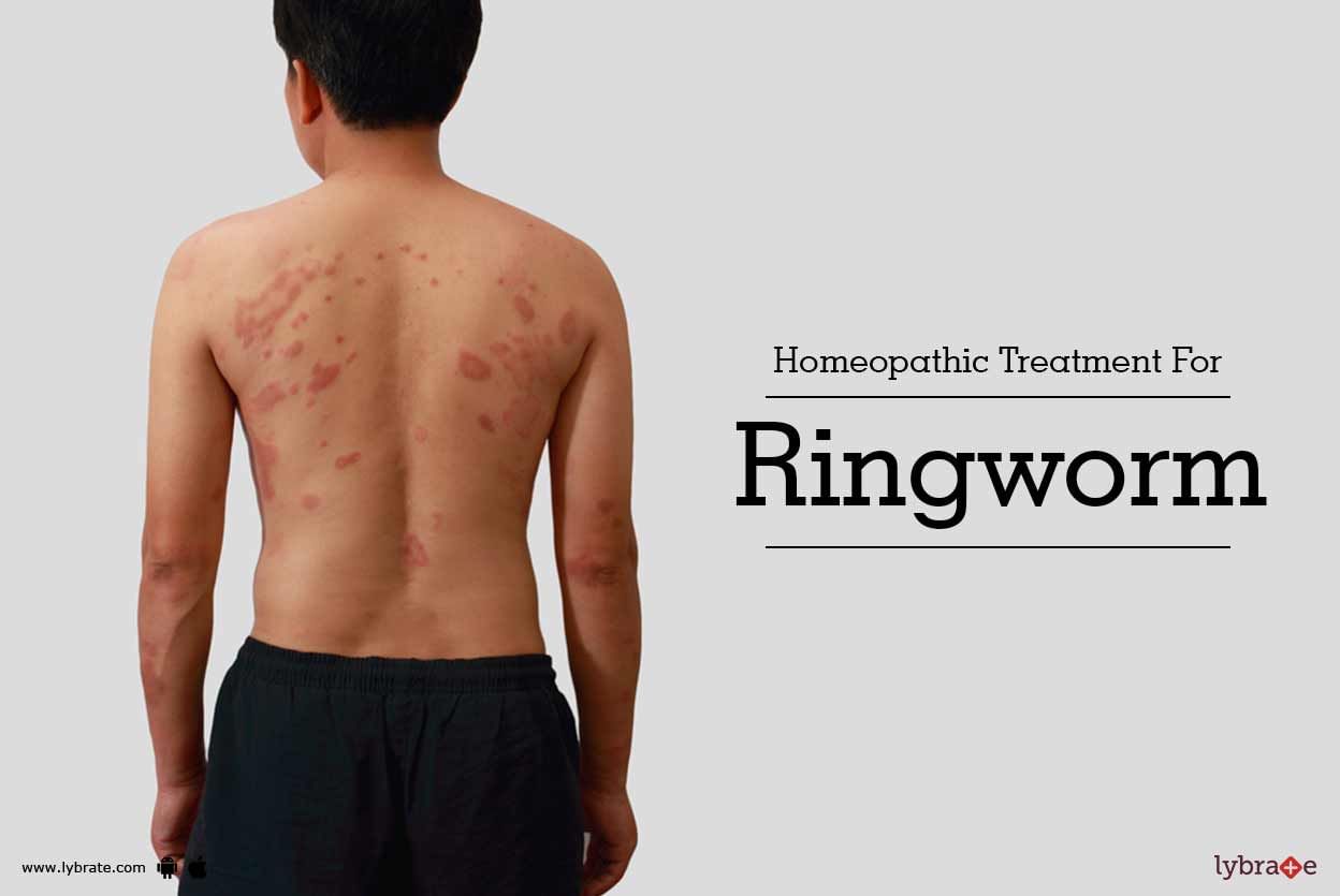 Homeopathic Treatment For Ringworm Fungal Infection