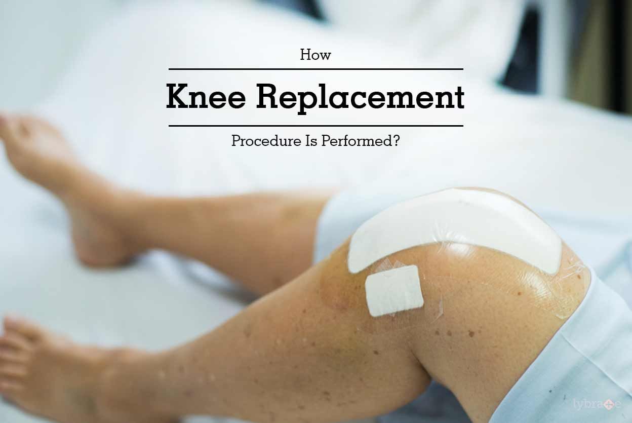 How Knee Replacement Procedure Is Performed?