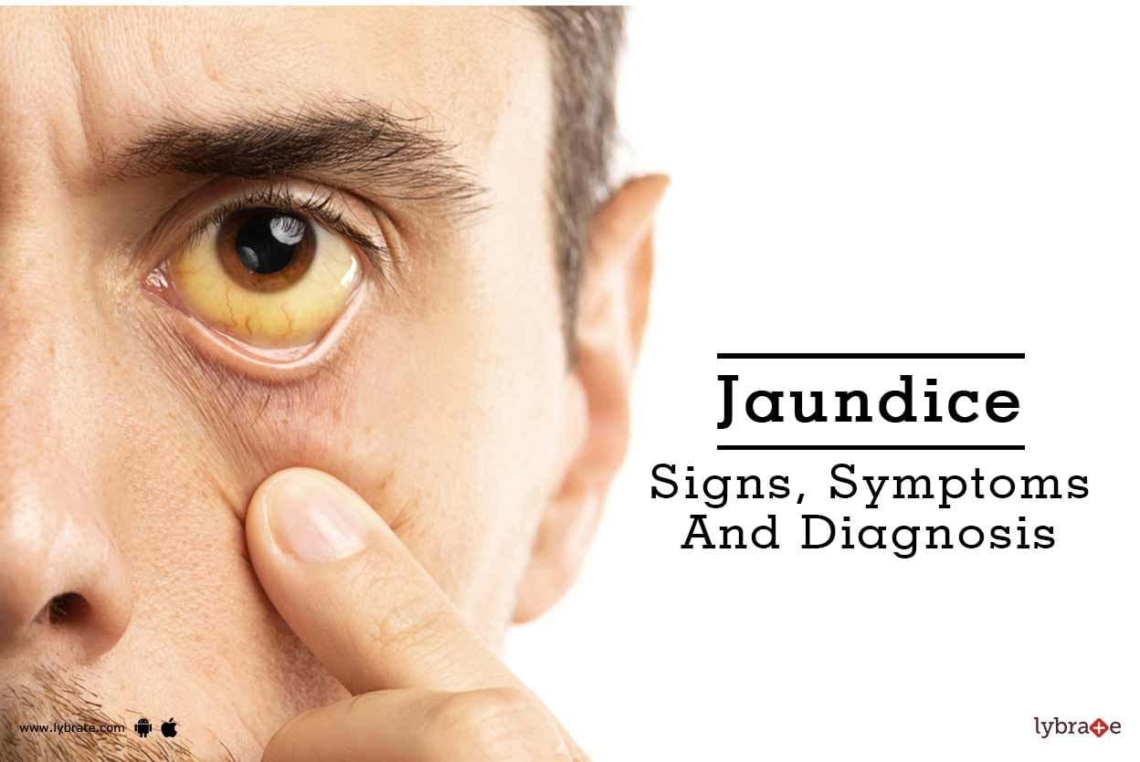 Jaundice - Signs, Symptoms And Diagnosis