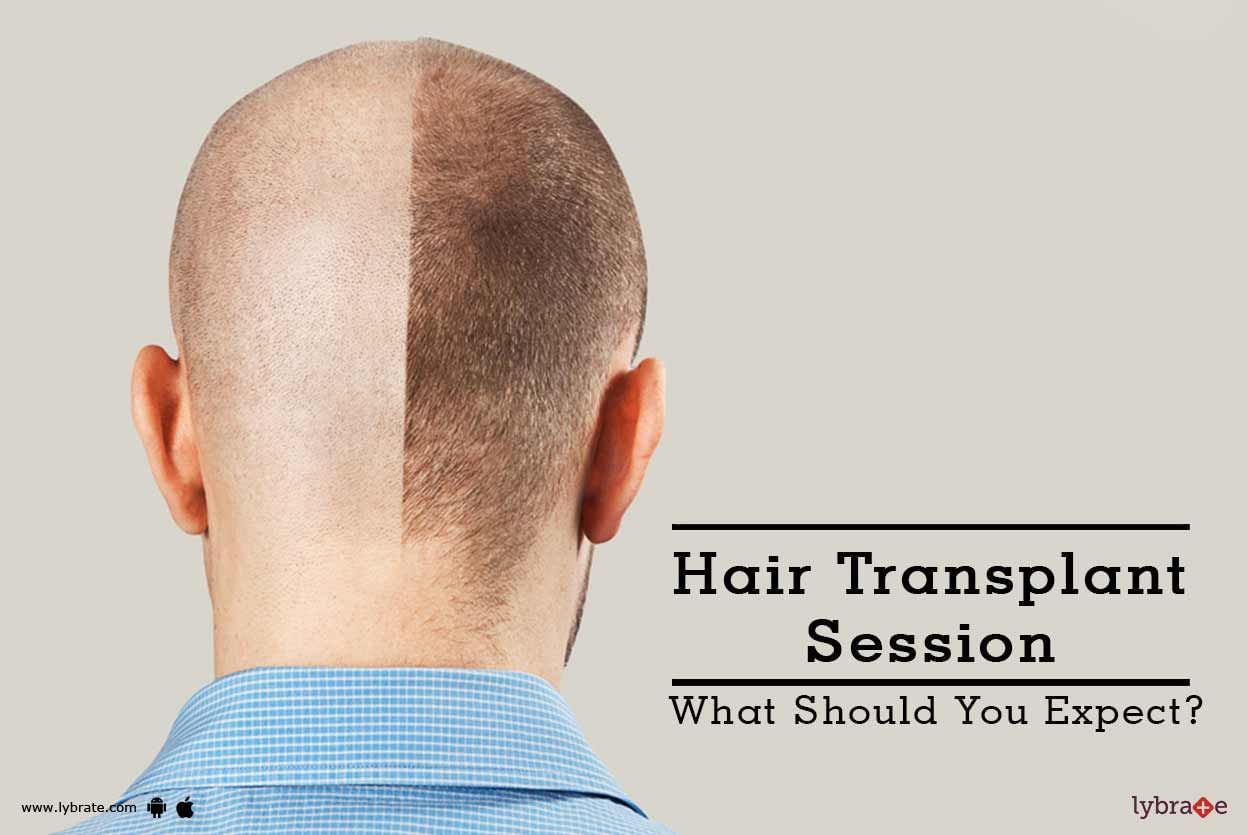 Hair Transplant Session - What Should You Expect?