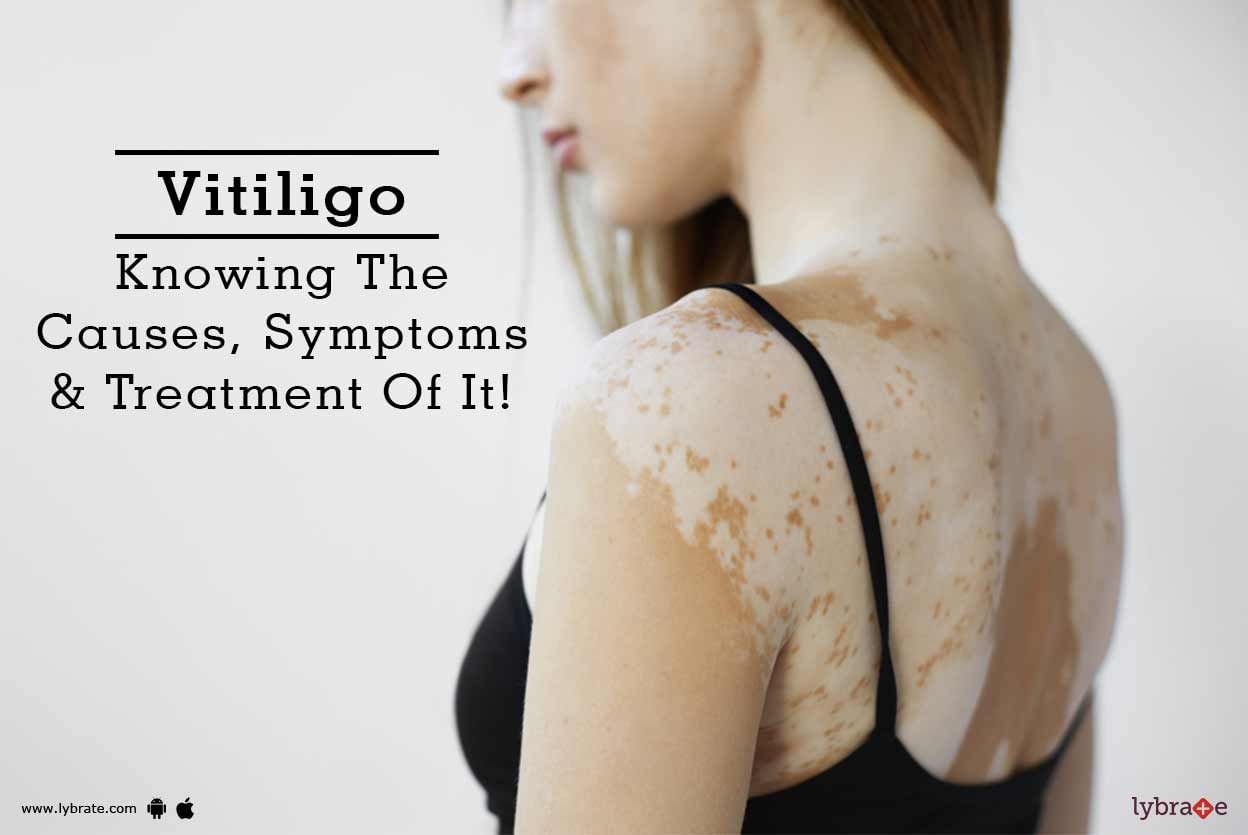 Vitiligo - Knowing The Causes, Symptoms & Treatment Of It!