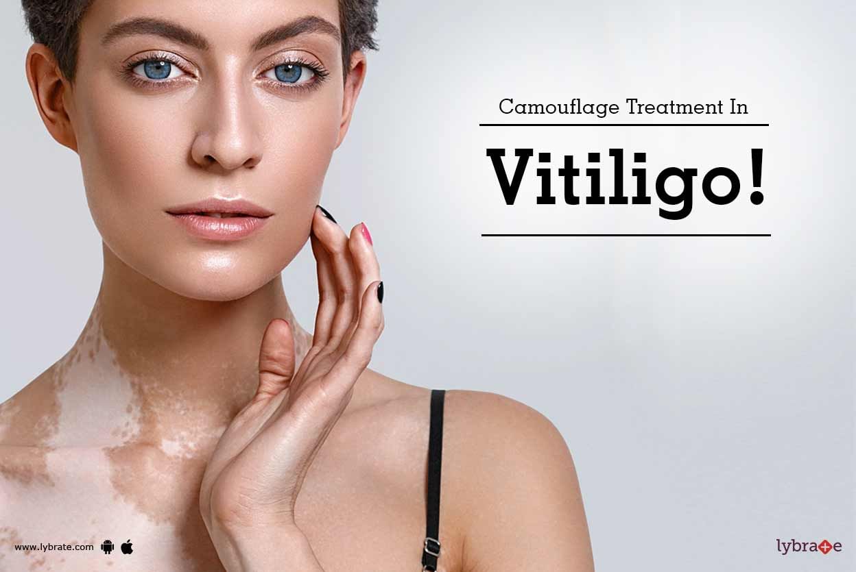 Camouflage Treatment In Vitiligo!