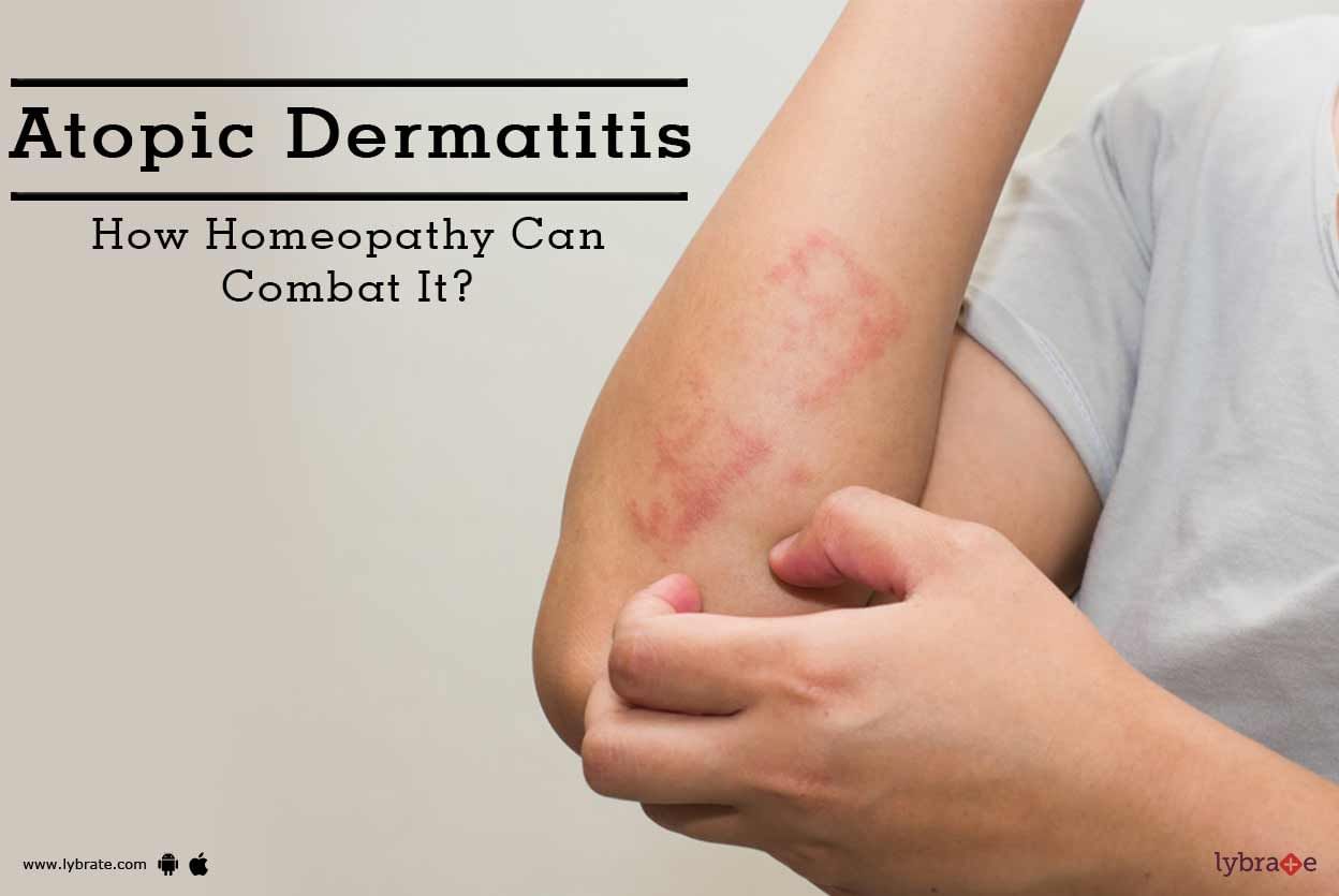 Atopic Dermatitis - How Homeopathy Can Combat It?