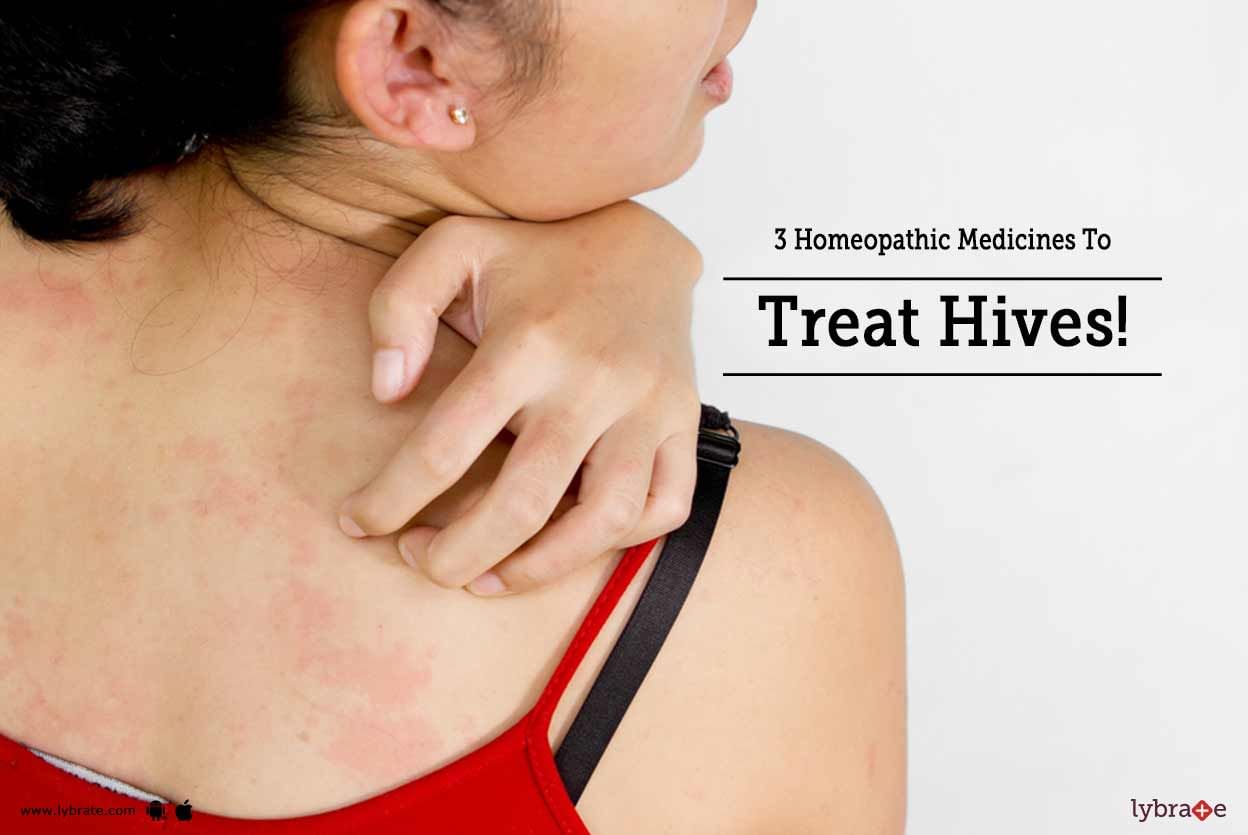 3 Homeopathic Medicines To Treat Hives!