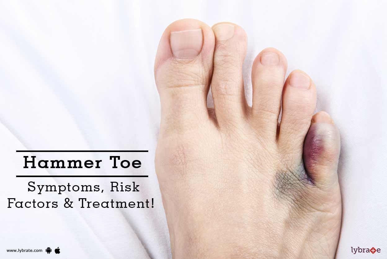 Hammer Toe - Symptoms, Risk Factors & Treatment!