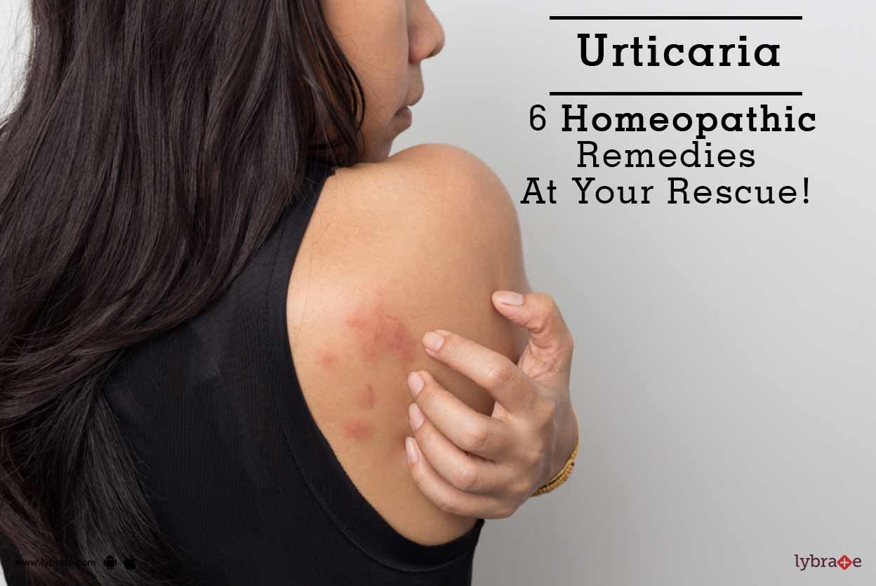Urticaria - 6 Homeopathic Remedies At Your Rescue!