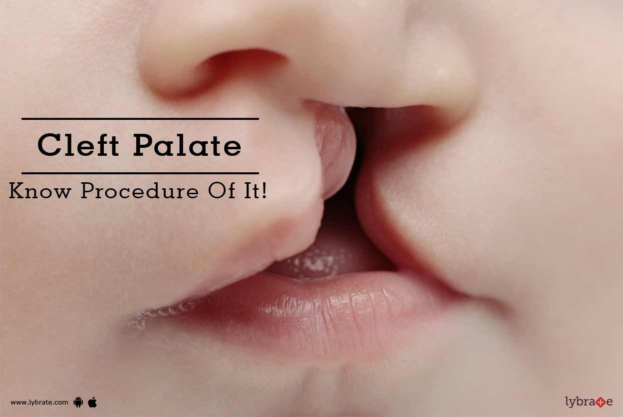 Cleft Palate - Know Procedure Of It!