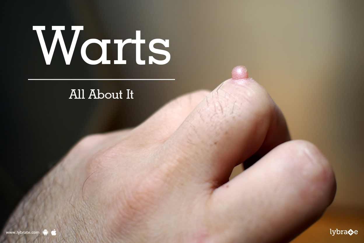 Warts: All About It