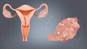 PCOS (Polycystic ovary Syndrome). What it means for your long- term health?