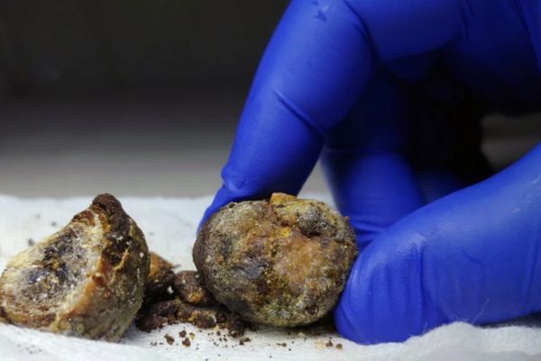 What Are The Risks Of Gallbladder Removal?